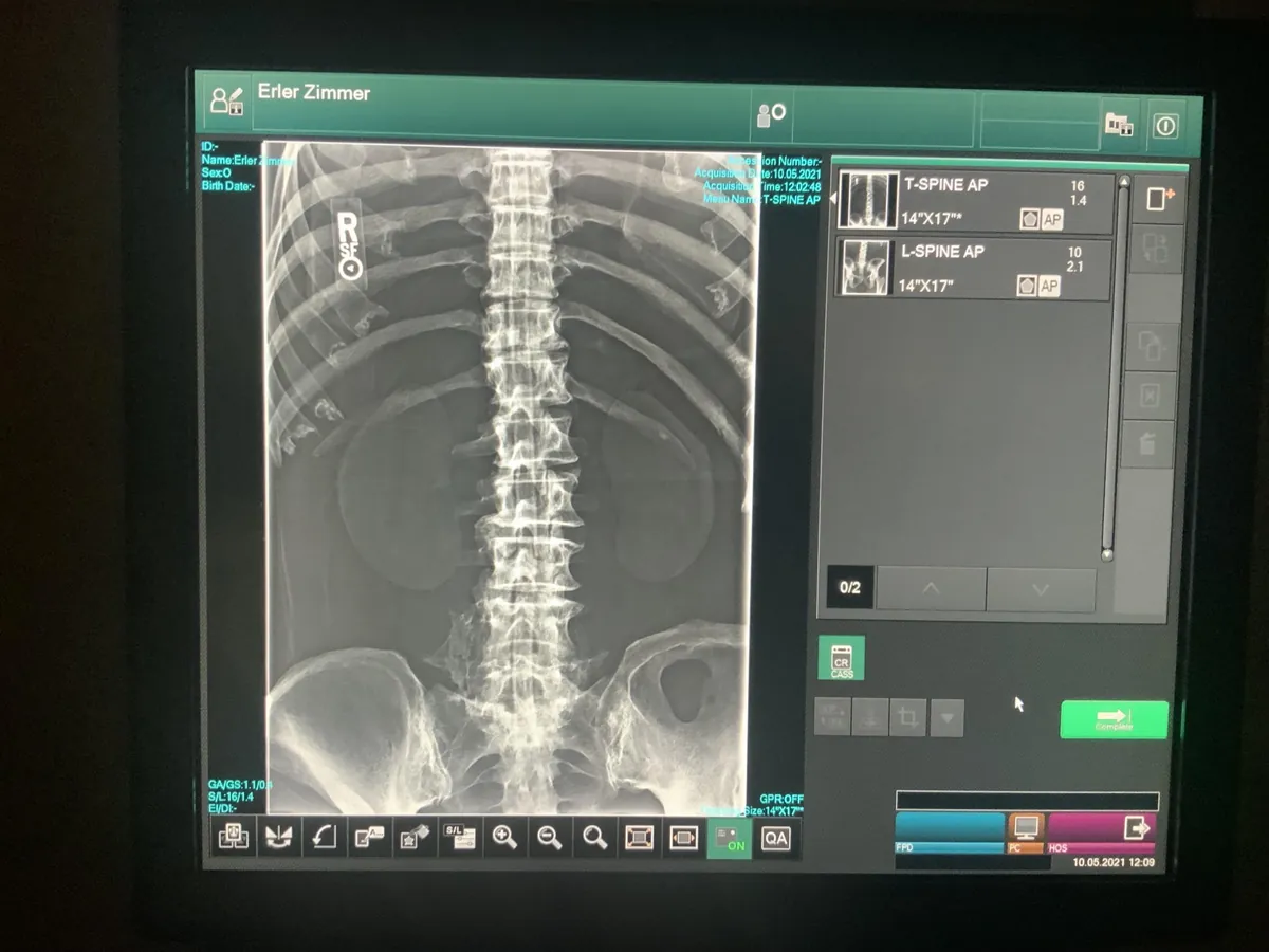 An exposure of a spine on a monitor