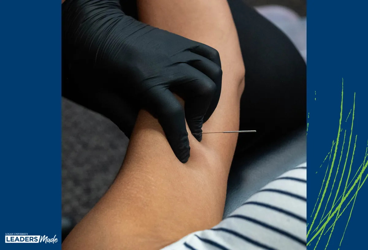 Understanding Dry Needling and Its Role in Healthcare